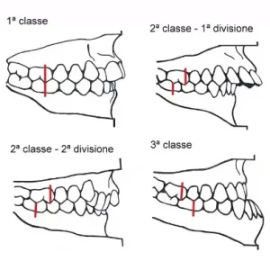 quattro immagini stilizzate di arcate dentali con i differenti allineamenti tra i denti con la suddivisione delle classi di angle